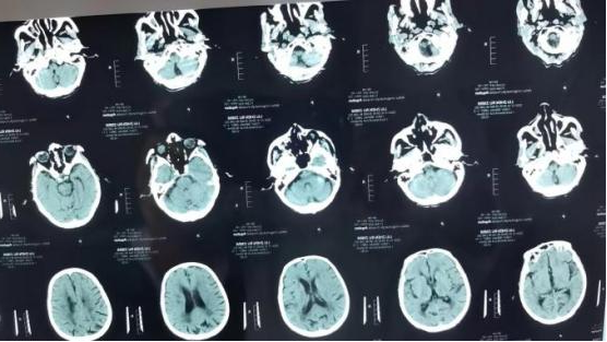 【专家驻点科室动态】安徽省荣军康复医院首例急性脑梗塞阿替普酶...